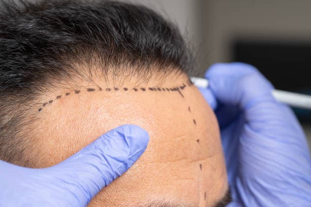 How Much Is Hair Transplant at Vivid Clinic Istanbul?
