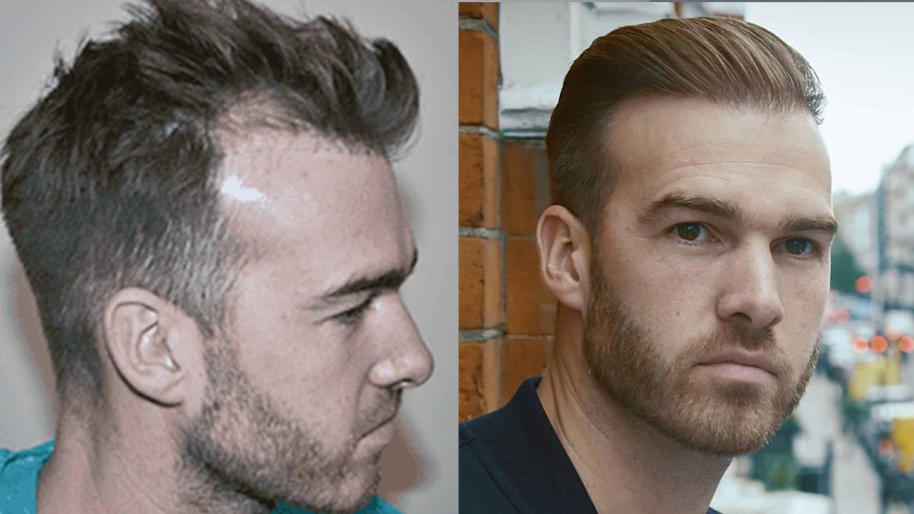 Discover Why Westminster Medical Group® Leads in Hair Transplant UK Services