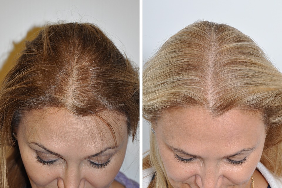 Hair Transplant Istanbul: World-Class Surgeons and Techniques