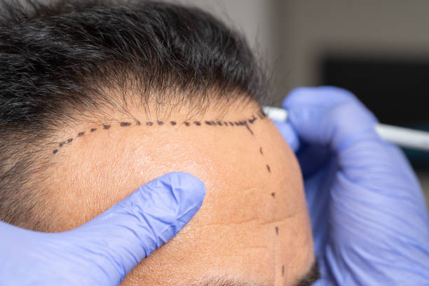 How Much Is Hair Transplant at Vivid Clinic Istanbul?
